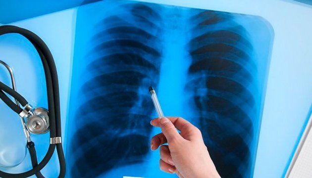 Сколько случаев туберкулеза зарегистрированы в прошлом году в Зеленодольском районе
