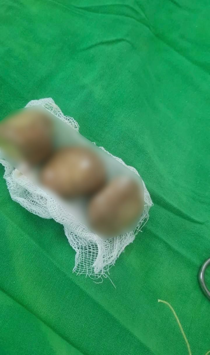 Камни величиной с перепелиные яйца удалили у пациента зеленодольские врачи