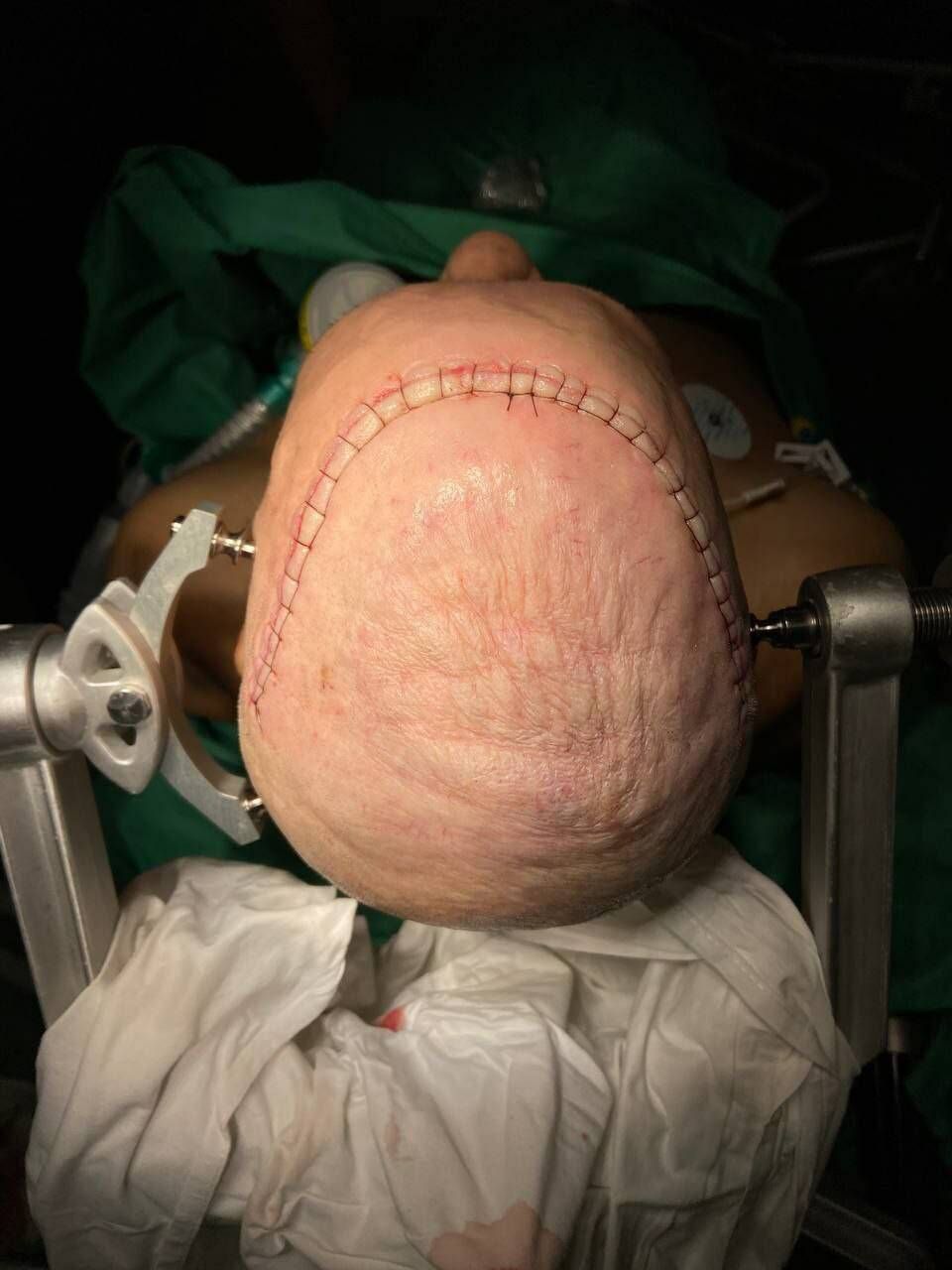 Татарстанские нейрохирурги спасли жизнь 78-летнему онкобольному