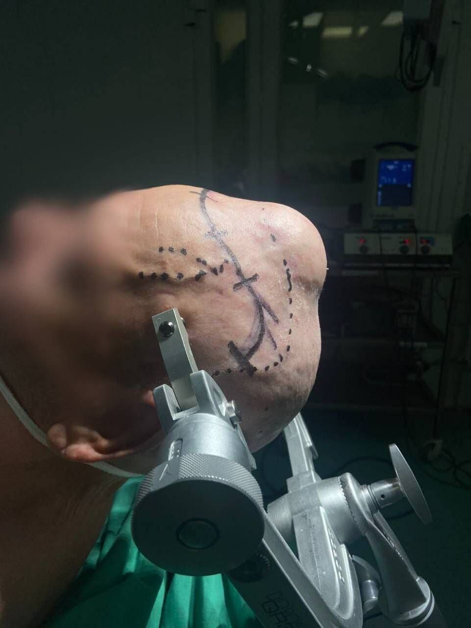 Татарстанские нейрохирурги спасли жизнь 78-летнему онкобольному