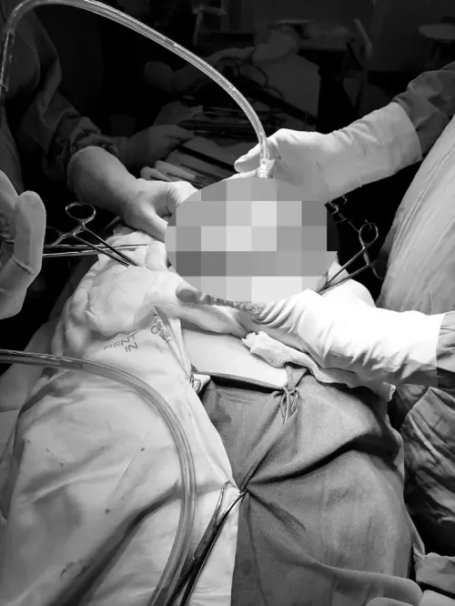 В Татарстане больнице у 88-летней пенсионерки вырезали гигантскую опухоль