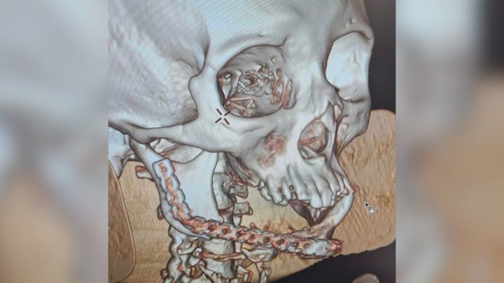 Жительнице Татарстана из-за сгнившей челюсти  провели операцию