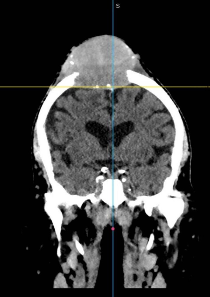 Татарстанские нейрохирурги спасли жизнь 78-летнему онкобольному