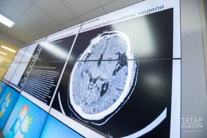 Почему молодеет инсульт: кардиолог Валентина Байдина объяснила причины